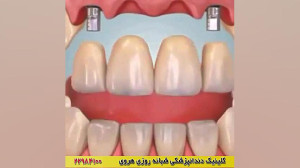 روش مناسب برای جایگزینی دندان...