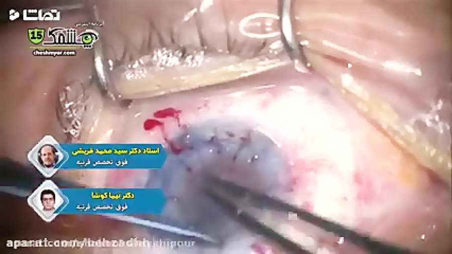 پیوند همزمان دو چشم  پیوند همز...