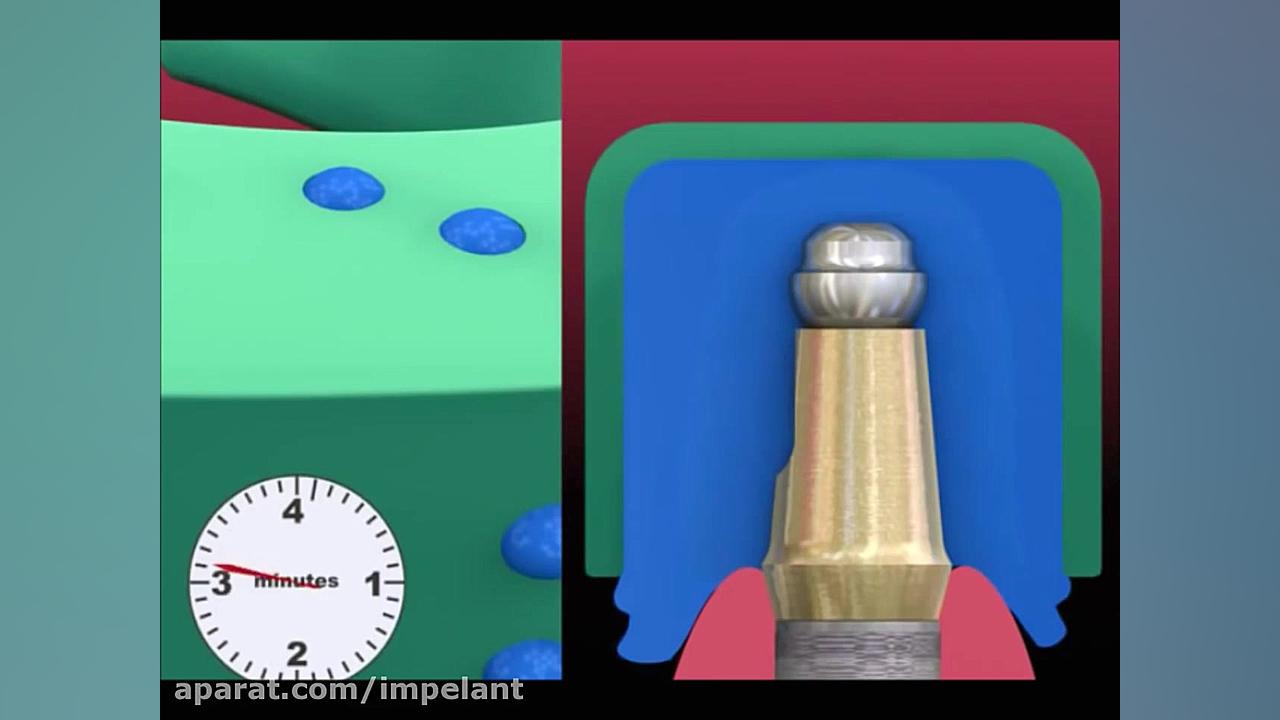 Dental Implant Procedure