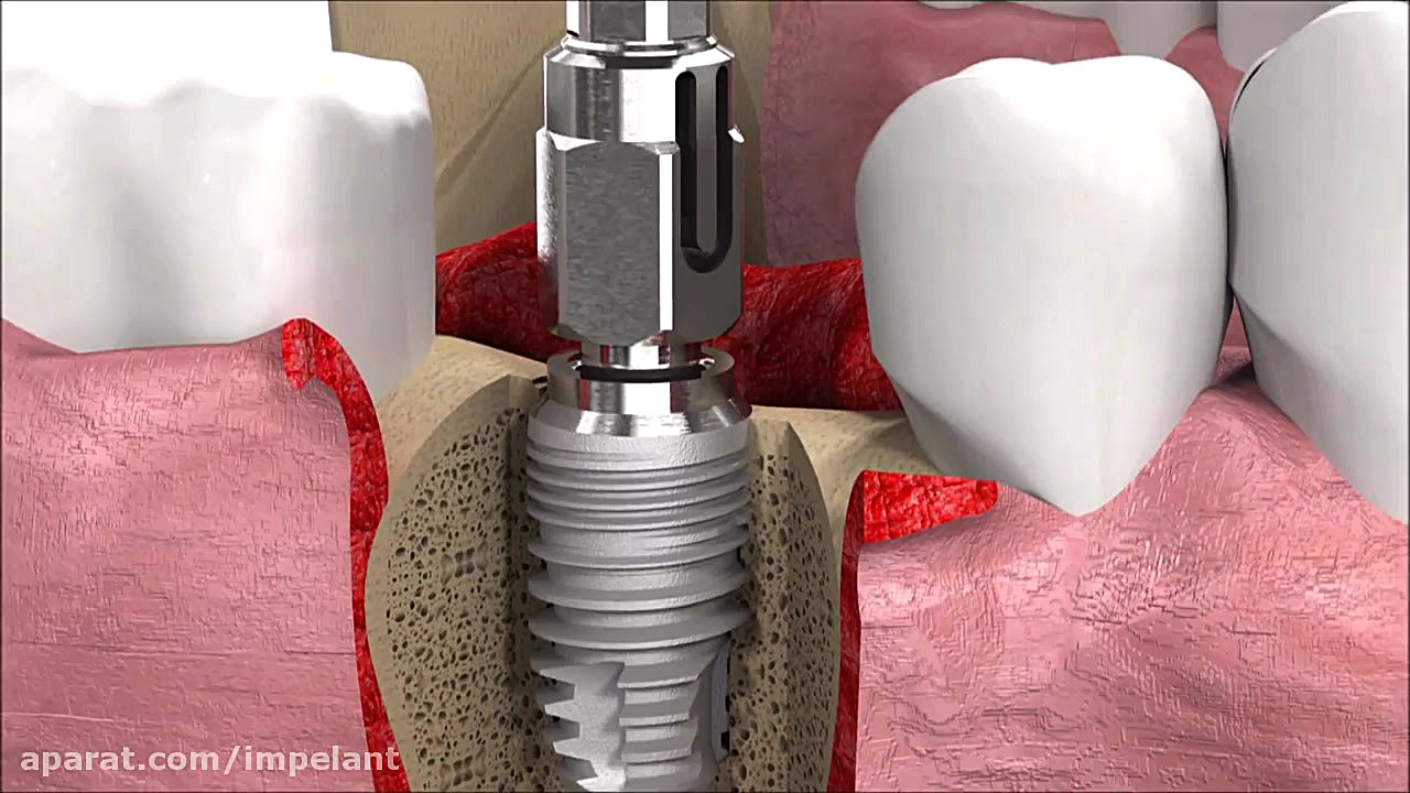 Dental Implant Procedure: SICm...