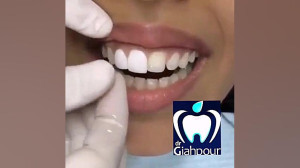 لمینت دندان در کلینیک دنتال ای...