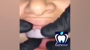 نحوه لمینت کردن دندان در کلینی...