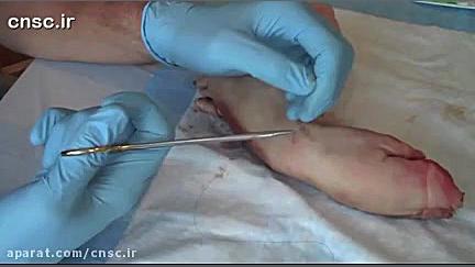 آموزش بخیه زدنَ