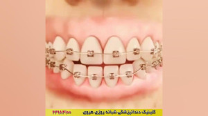فیلم اصلاح جلوزدگی فک پایین