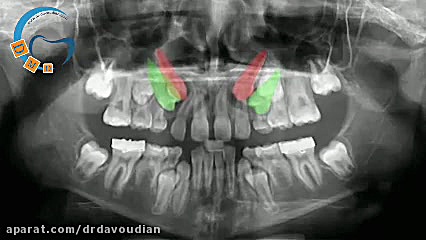 هدایت نیش نهفته در ارتودنسی |...