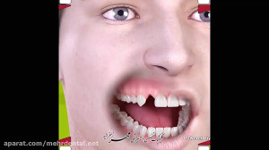 ایمپلنت ( کاشت دندان ) | کلینی...